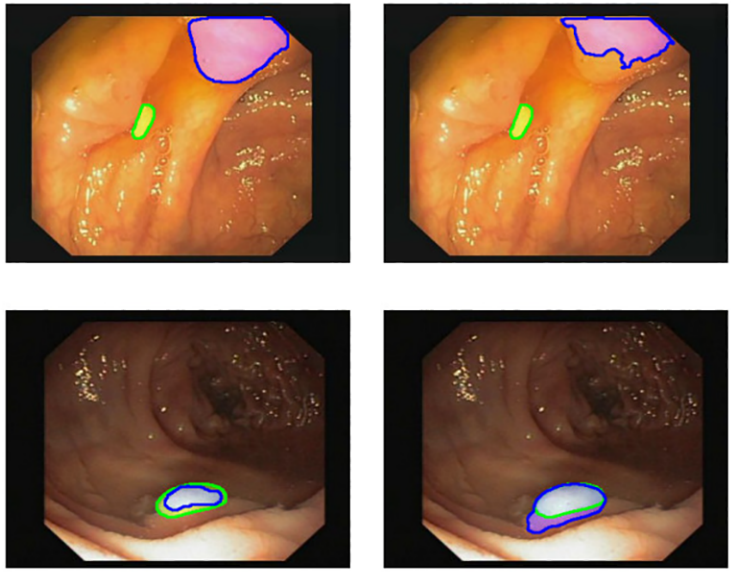 Polyp segmentation benchmark comparison